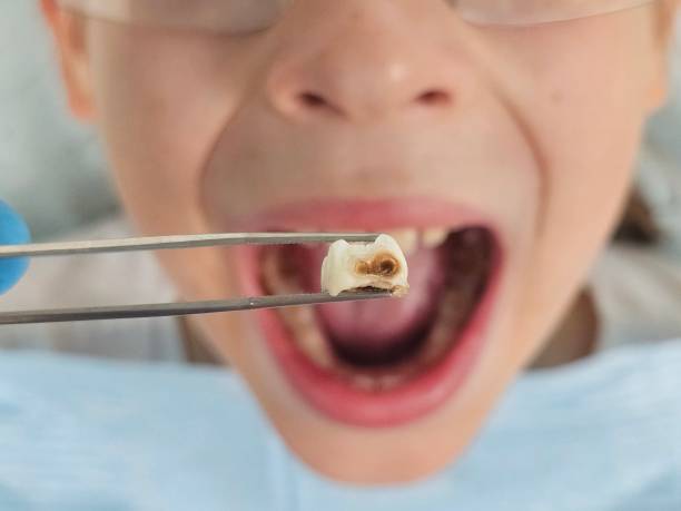 Best Emergency Treatment for Dental Infections or Abscesses in Haslett, MI